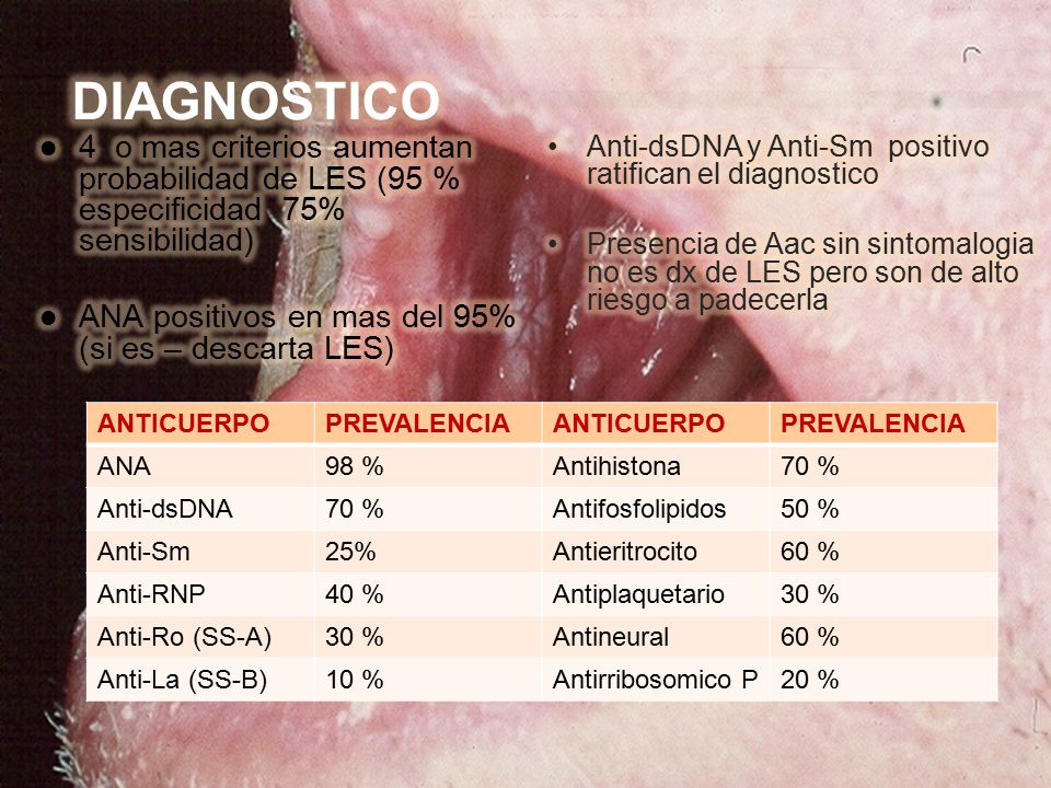 DIAGNOSTICO 4 o mas criterios aumentan probabilidad de LES (95 % especificidad 75% sensibilidad)