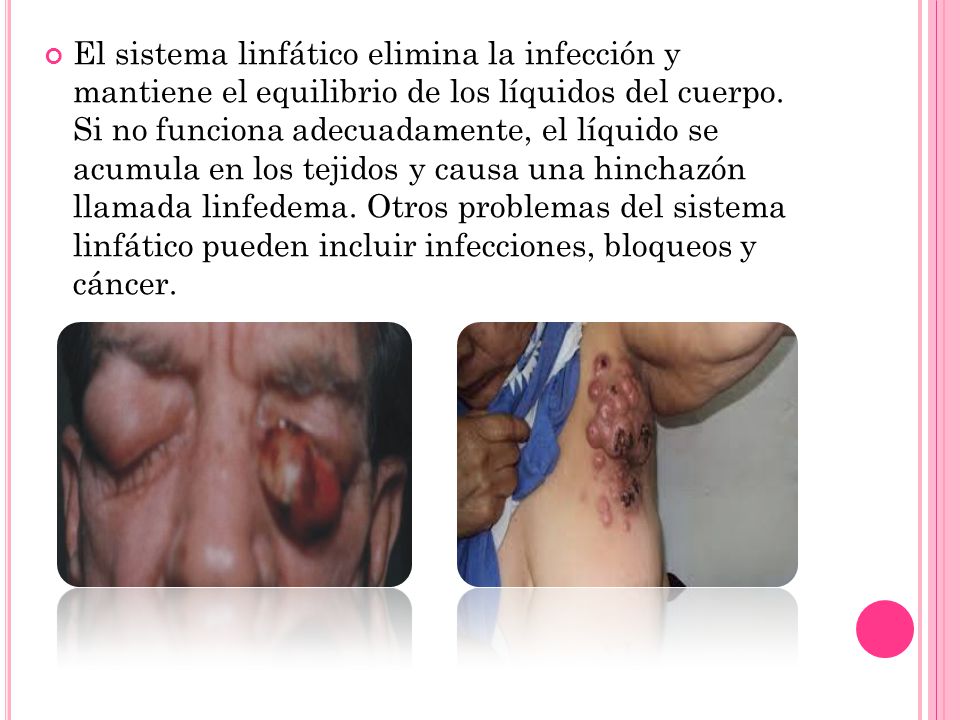El sistema linfático elimina la infección y mantiene el equilibrio de los líquidos del cuerpo.