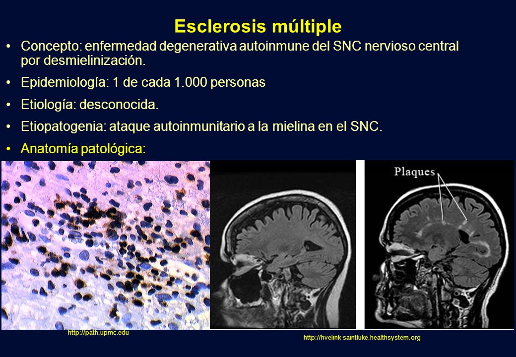 Esclerosis múltiple Concepto: enfermedad degenerativa autoinmune del SNC nervioso central por desmielinización.