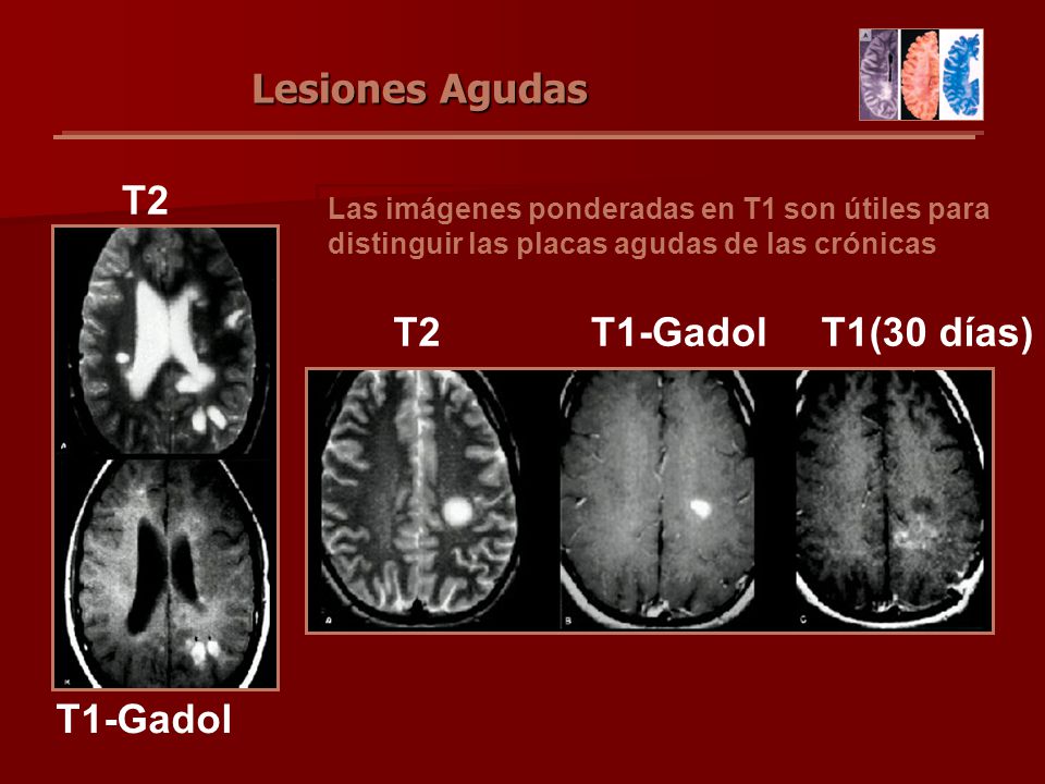 Lesiones Agudas T2 T2 T1-Gadol T1(30 días) T1-Gadol