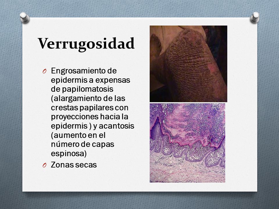 Verrugosidad