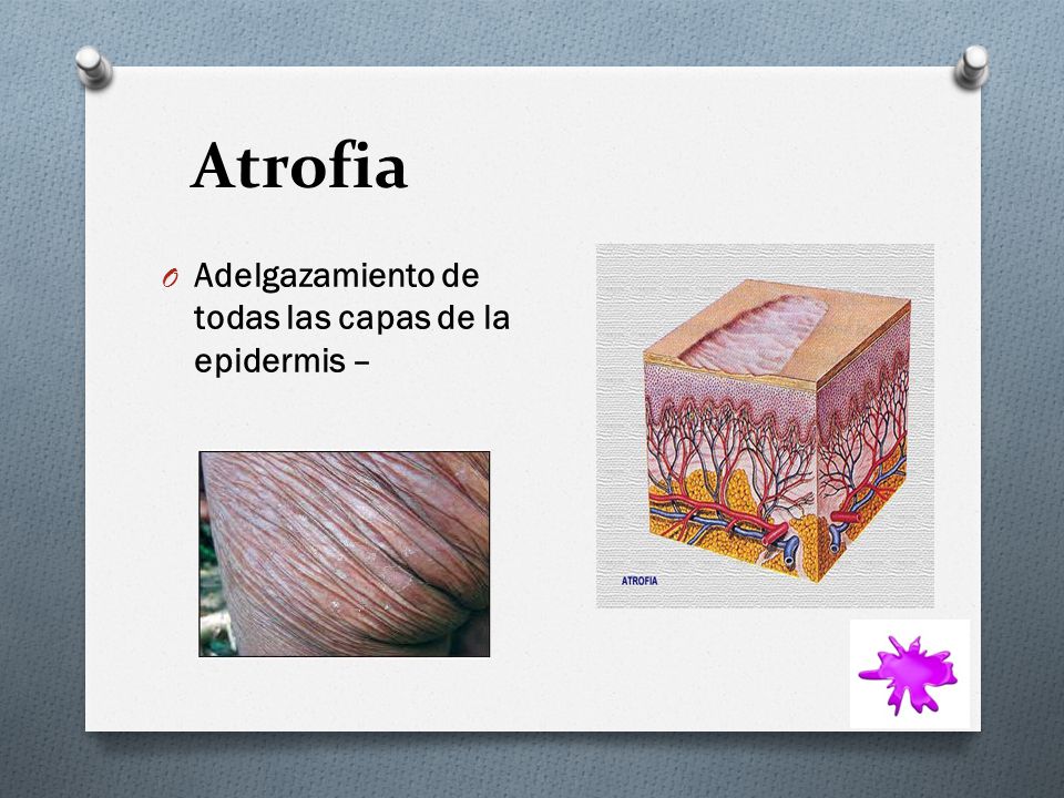 Atrofia Adelgazamiento de todas las capas de la epidermis –