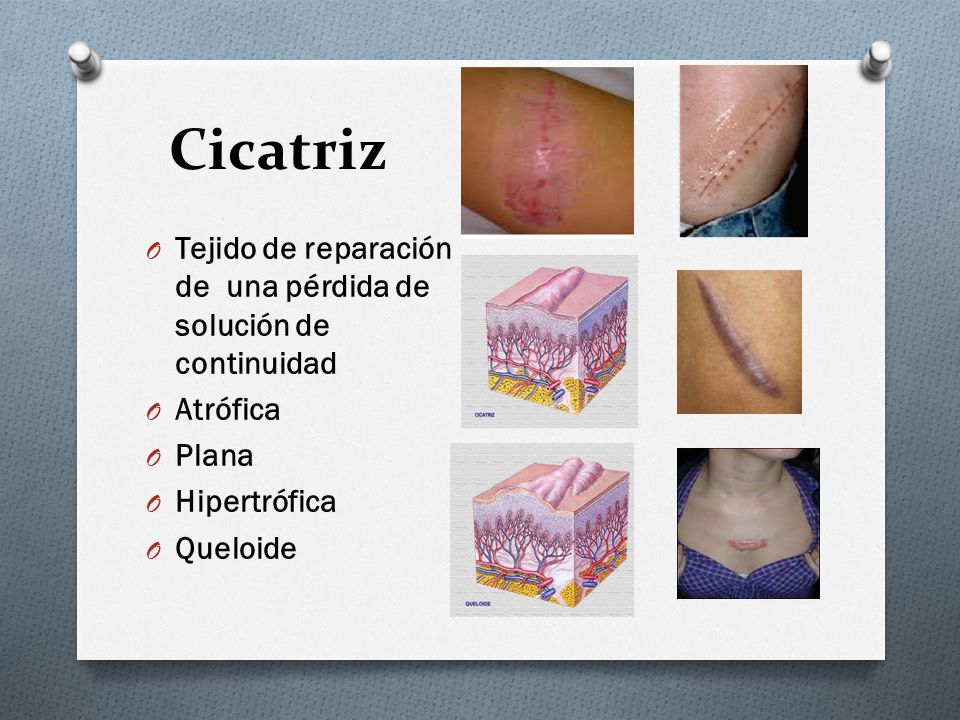 Cicatriz Tejido de reparación de una pérdida de solución de continuidad. Atrófica. Plana. Hipertrófica.