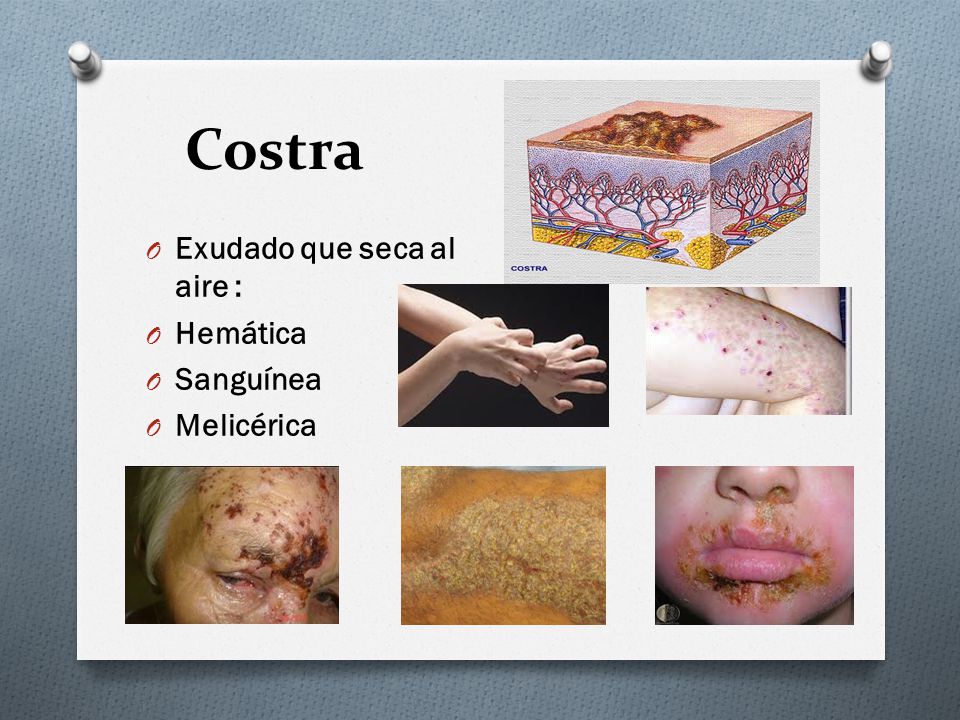 Costra Exudado que seca al aire : Hemática Sanguínea Melicérica