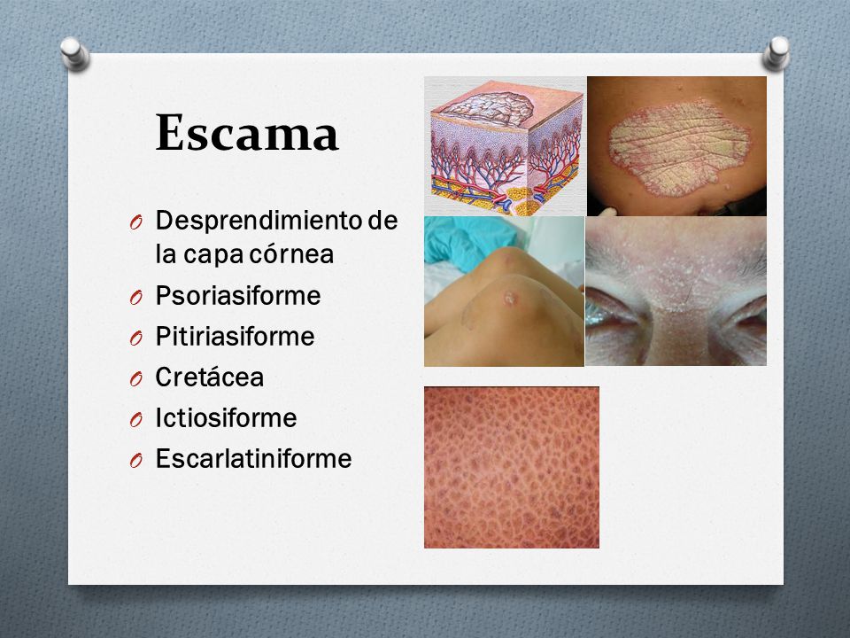 Escama Desprendimiento de la capa córnea Psoriasiforme Pitiriasiforme