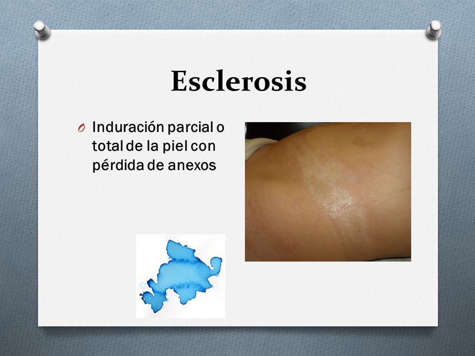 Esclerosis Induración parcial o total de la piel con pérdida de anexos
