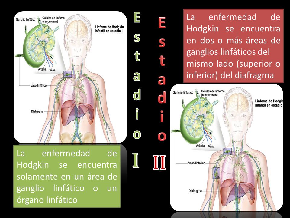 Estadio La enfermedad de Hodgkin se encuentra en dos o más áreas de ganglios linfáticos del. mismo lado (superior o inferior) del diafragma.