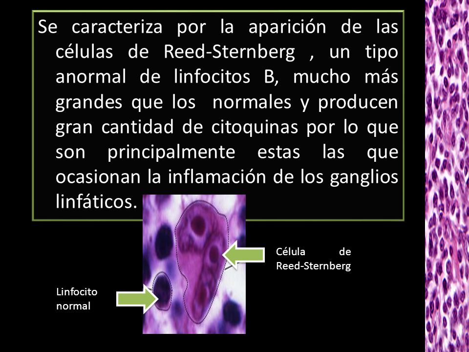 Se caracteriza por la aparición de las células de Reed-Sternberg , un tipo anormal de linfocitos B, mucho más grandes que los normales y producen gran cantidad de citoquinas por lo que son principalmente estas las que ocasionan la inflamación de los ganglios linfáticos.
