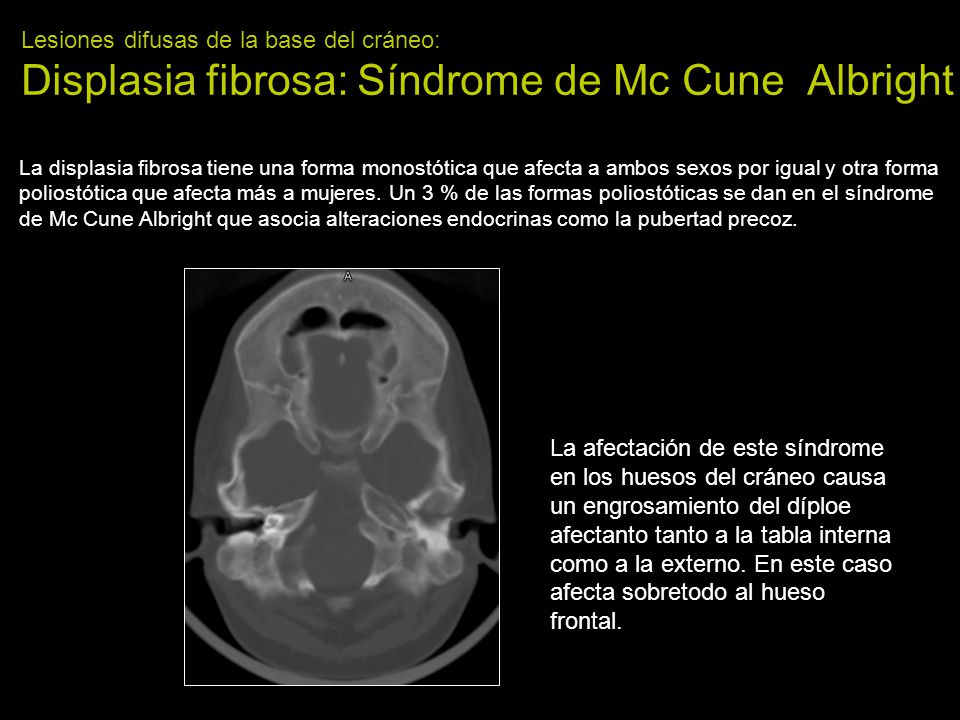 Lesiones difusas de la base del cráneo: Displasia fibrosa: Síndrome de Mc Cune Albright