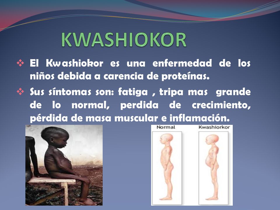 KWASHIOKOR El Kwashiokor es una enfermedad de los niños debida a carencia de proteínas.