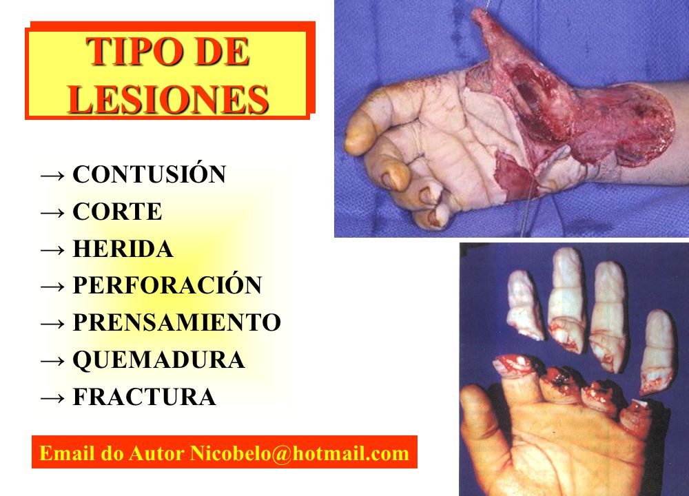 TIPO DE LESIONES + → CONTUSIÓN → CORTE → HERIDA → PERFORACIÓN