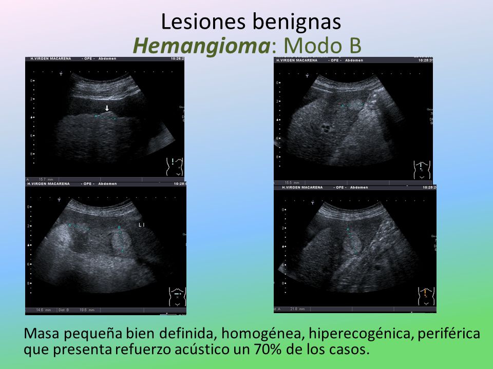 Lesiones benignas Hemangioma: Modo B