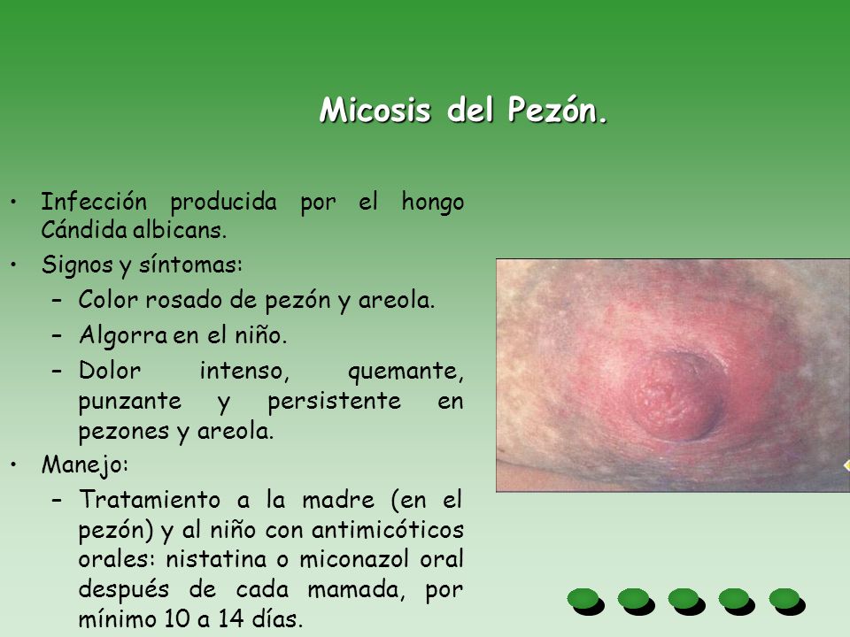 Micosis del Pezón. Color rosado de pezón y areola. Algorra en el niño.