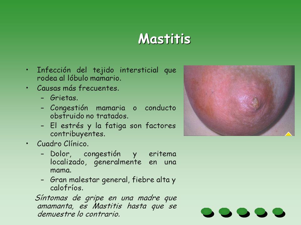 Mastitis Infección del tejido intersticial que rodea al lóbulo mamario. Causas más frecuentes. Grietas.