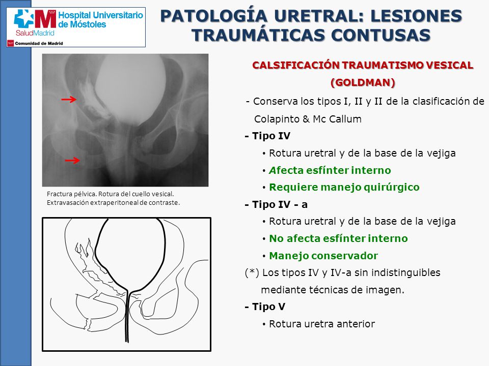 PATOLOGÍA URETRAL: LESIONES TRAUMÁTICAS CONTUSAS