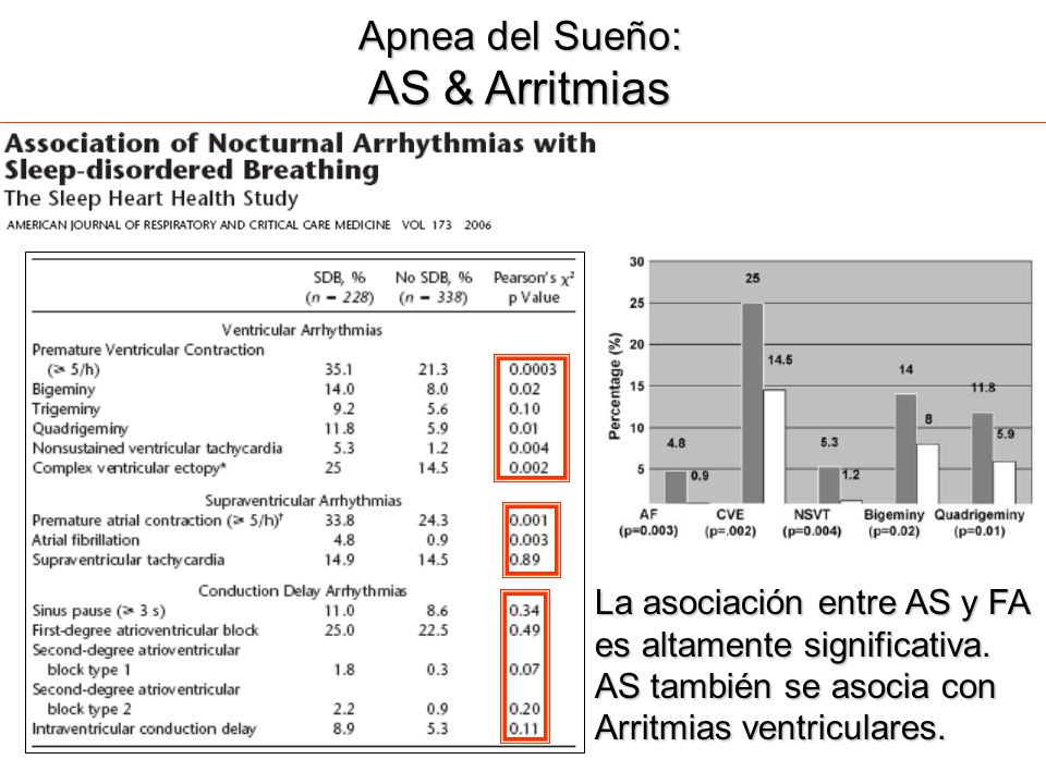 AS & Arritmias Apnea del Sueño: La asociación entre AS y FA