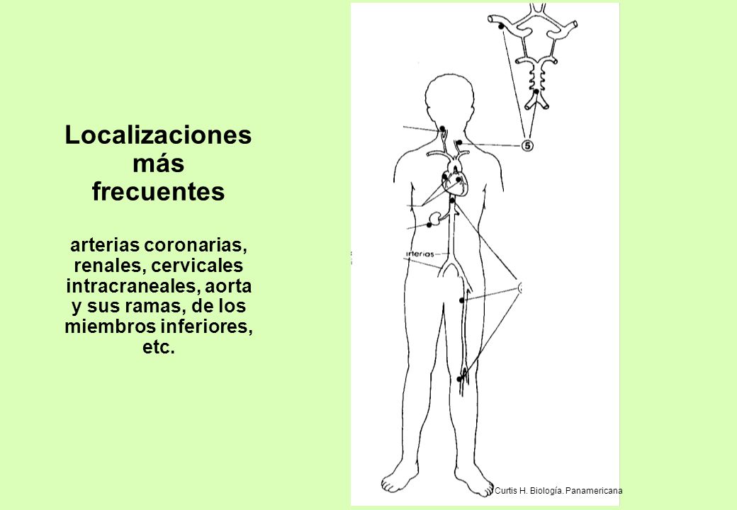 Localizaciones más frecuentes arterias coronarias, renales, cervicales intracraneales, aorta y sus ramas, de los miembros inferiores, etc.