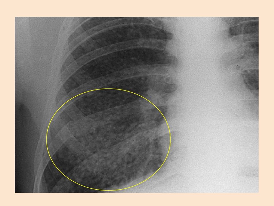 Se muestra una radiografía de tórax que presenta signos de tuberculosis miliar.