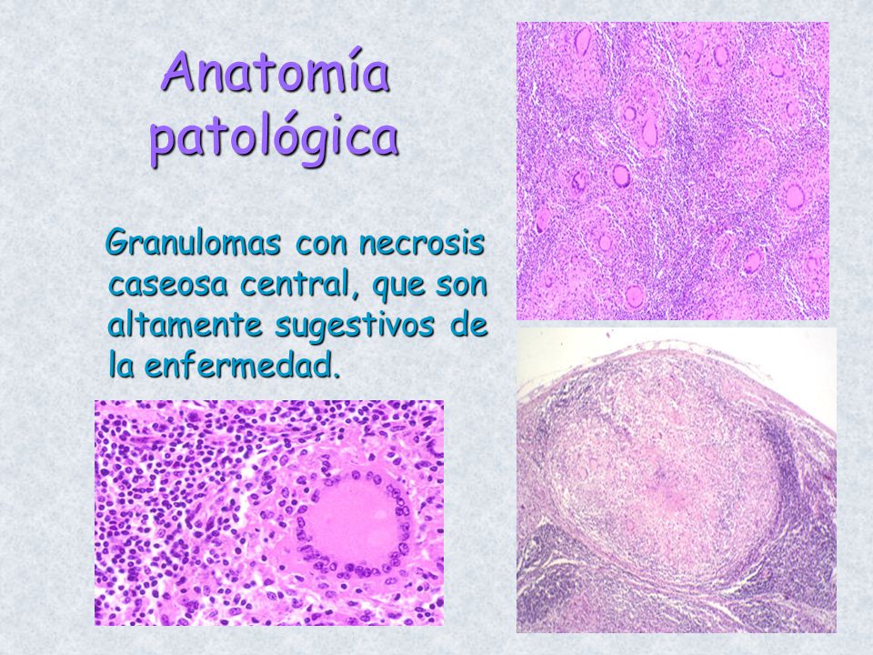 Anatomía patológica Granulomas con necrosis caseosa central, que son altamente sugestivos de la enfermedad.