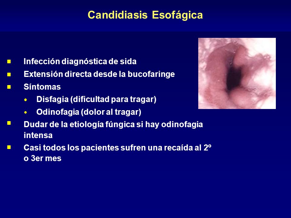 Candidiasis Esofágica
