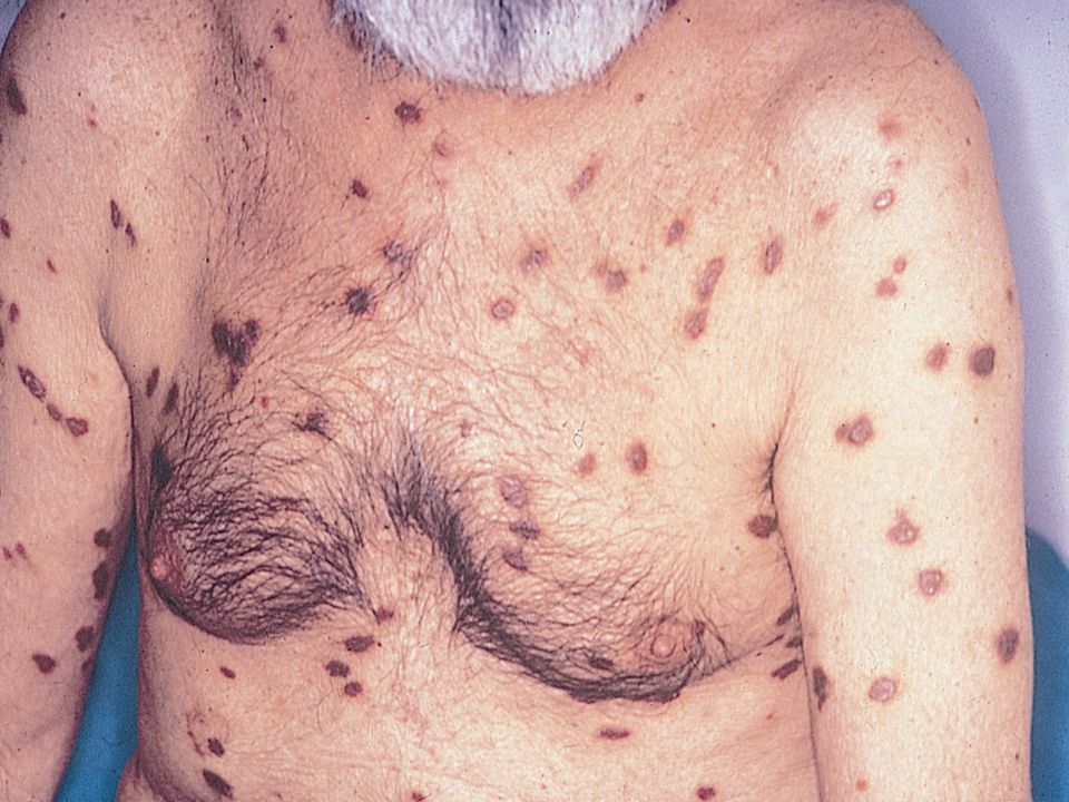 En esta diapositiva puede observarse un paciente con múltiples lesiones cutáneas típicas de sarcoma de Kaposi, violáceas y sobreelevadas. Cuando están en actividad algunas de ellas pueden tener un halo amarillento alrededor y cuando responden al tratamiento el halo desaparece, las lesiones se aplanan y cambian de color volviéndose marrones.