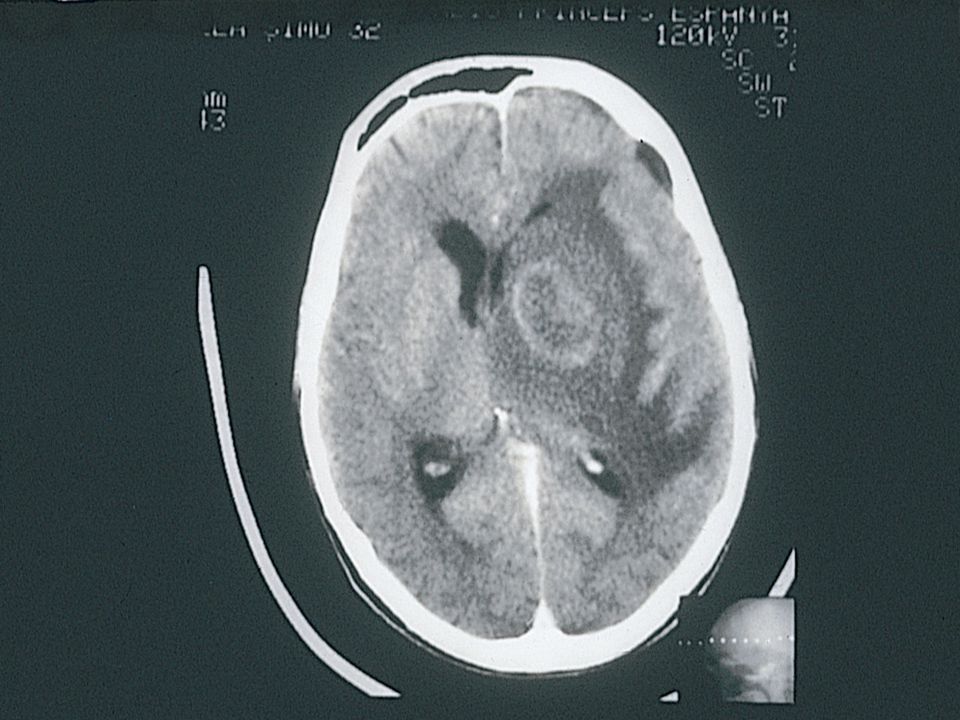 La encefalitis toxoplásmica es la infección secundaria del sistema nervioso central más frecuente en pacientes VIH+. Suele aparecer por reactivación de una infección latente en pacientes inmunodeprimidos (CD4 < 100/uL) con serología positiva para T. gondii. Se presenta con síntomas neurológicos inespecíficos con o sin fiebre y en la TAC craneal el patrón más habitual es el de una o varias imágenes localizadas en anillo con captación de contraste, edema perilesional y efecto de masa, como se aprecia en esta diapositiva. En la RNM se suelen observar lesiones múltiples. El diagnóstico diferencial se debe hacer principalmente con el linfoma cerebral: éste debe sospecharse en pacientes con serología negativa para T. gondii, profilaxis anti-toxoplasma correcta o imágenes únicas en la TAC y sobre todo en la RNM.