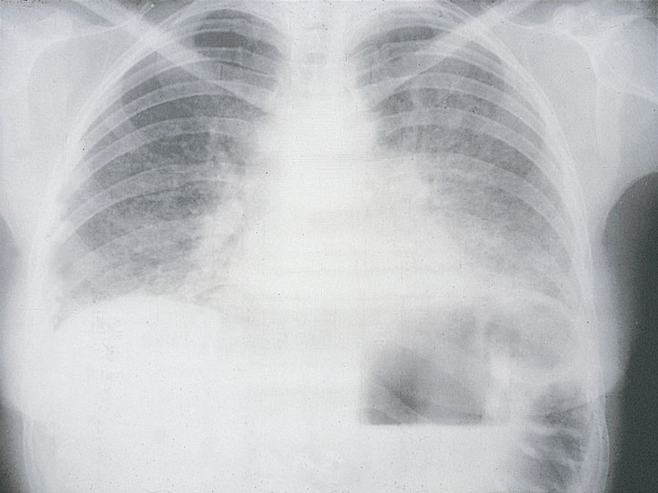 La neumonia por Pneumocystis carinii (PCP) es la infección oportunista más frecuente en pacientes con SIDA en EEUU y la segunda después de la tuberculosis en España.