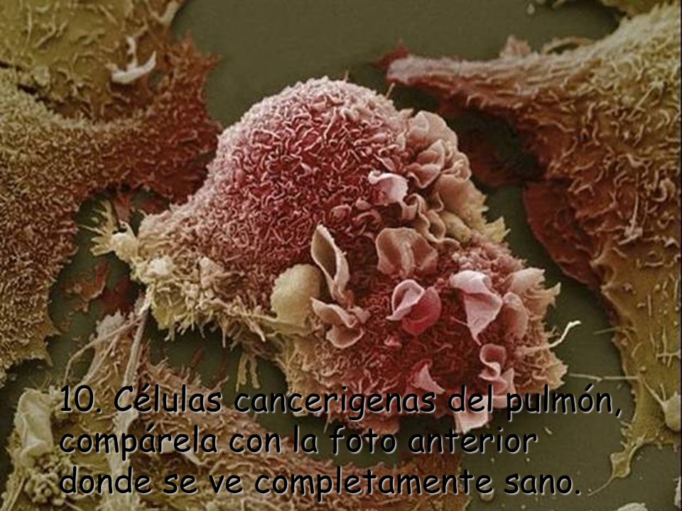 10. Células cancerigenas del pulmón, compárela con la foto anterior donde se ve completamente sano.