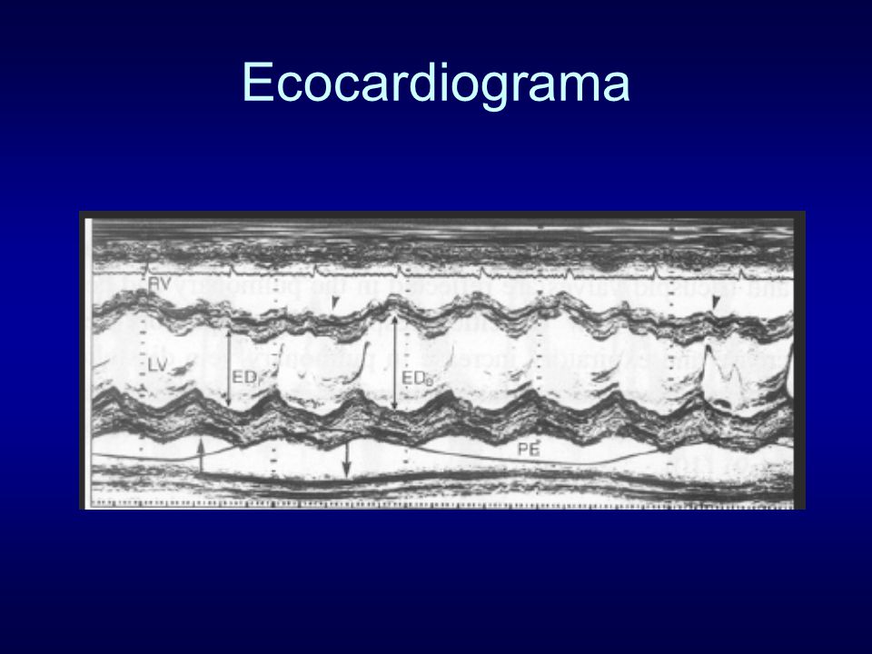 Ecocardiograma With Inspiration: 1) The septum moves posterior, 2) RV diameter. increases, and 3) LV diameter decreases.