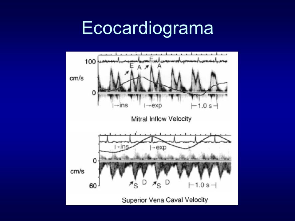 Ecocardiograma Figure 6. Doppler mitral flow and superior vena caval velocity in. a patient with pericardial constriction. There is marked (25%)