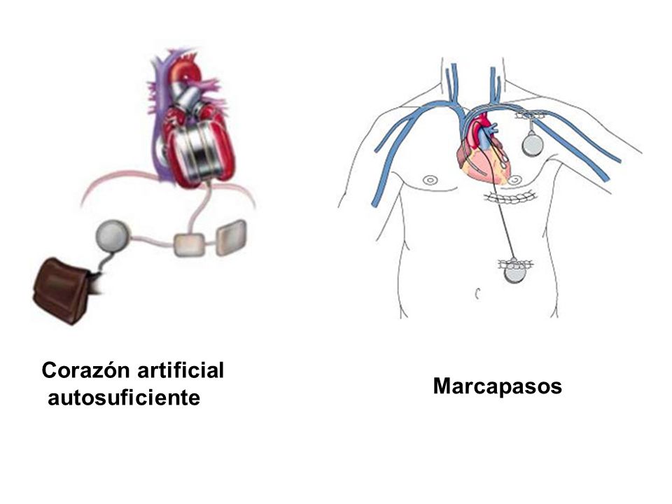 Corazón artificial autosuficiente Marcapasos