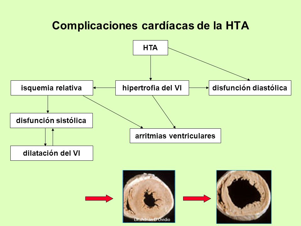 Complicaciones cardíacas de la HTA
