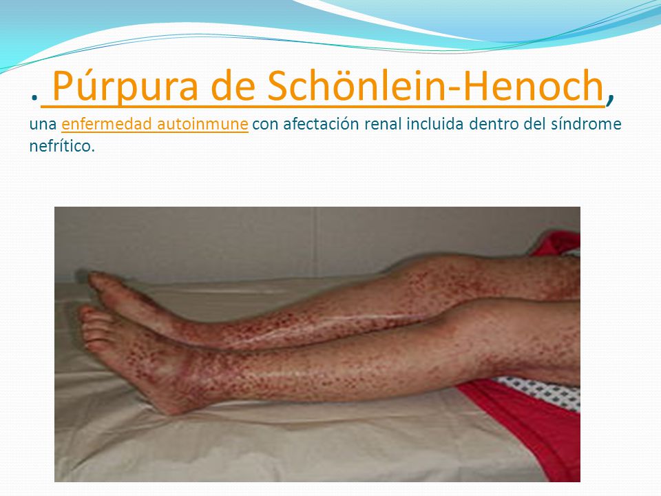 . Púrpura de Schönlein-Henoch, una enfermedad autoinmune con afectación renal incluida dentro del síndrome nefrítico.