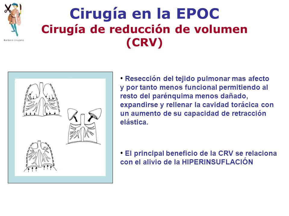Cirugía en la EPOC Cirugía de reducción de volumen (CRV)