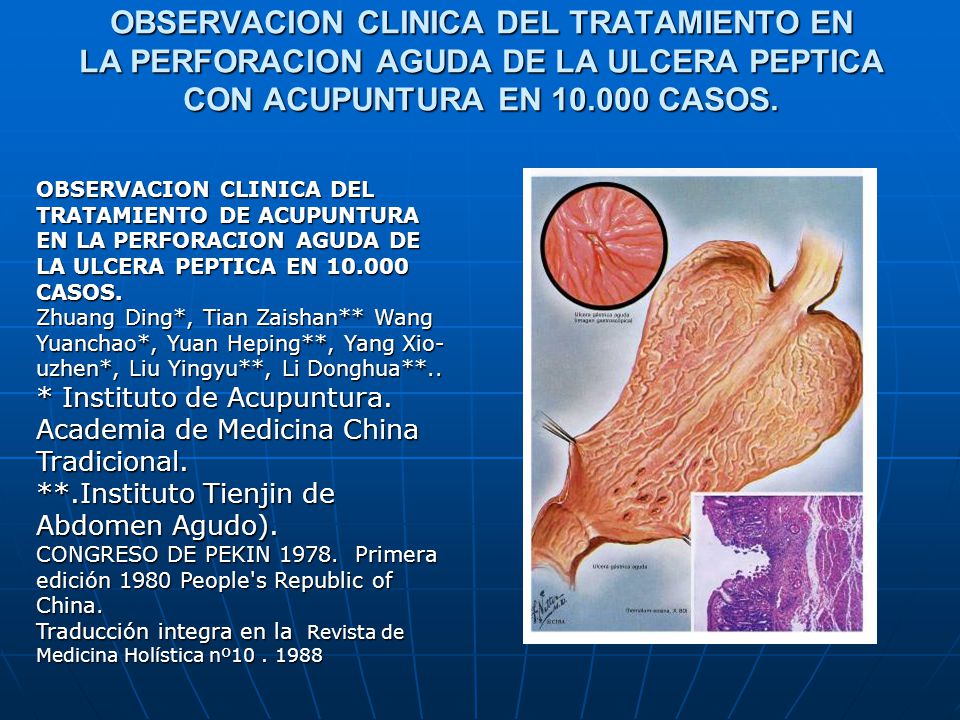 OBSERVACION CLINICA DEL TRATAMIENTO EN LA PERFORACION AGUDA DE LA ULCERA PEPTICA CON ACUPUNTURA EN CASOS.