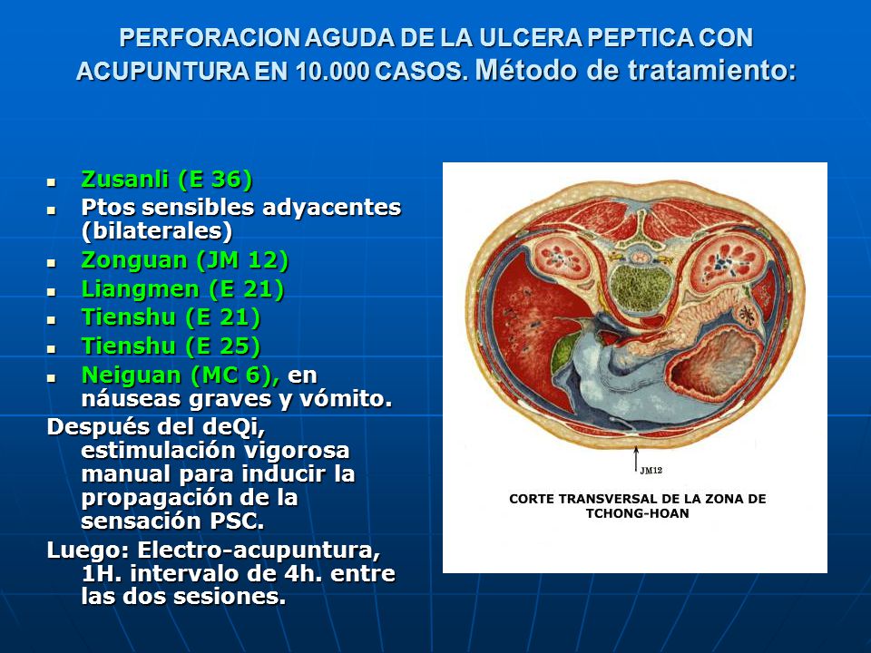 PERFORACION AGUDA DE LA ULCERA PEPTICA CON ACUPUNTURA EN CASOS