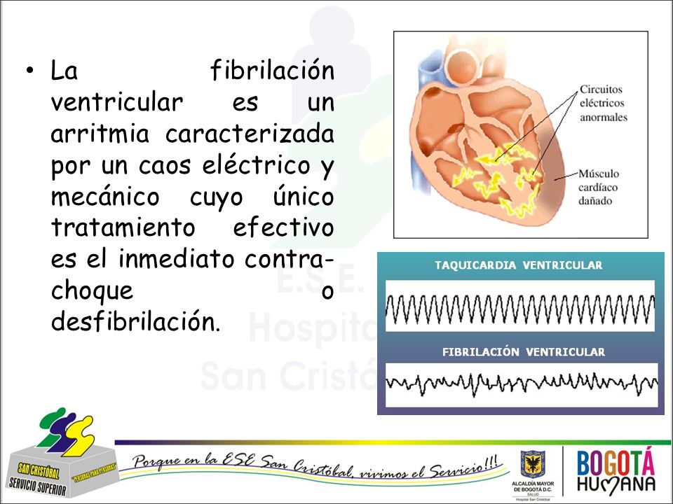 La fibrilación ventricular es un arritmia caracterizada por un caos eléctrico y mecánico cuyo único tratamiento efectivo es el inmediato contra-choque o desfibrilación.