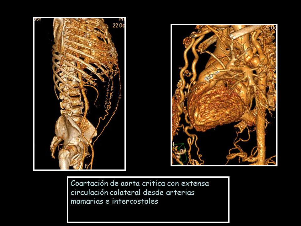 Coartación de aorta critica con extensa circulación colateral desde arterias mamarias e intercostales
