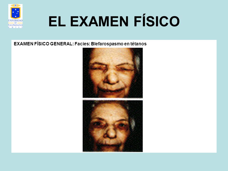 EL EXAMEN FÍSICO EXAMEN FÍSICO GENERAL: Facies: Blefarospasmo en tétanos