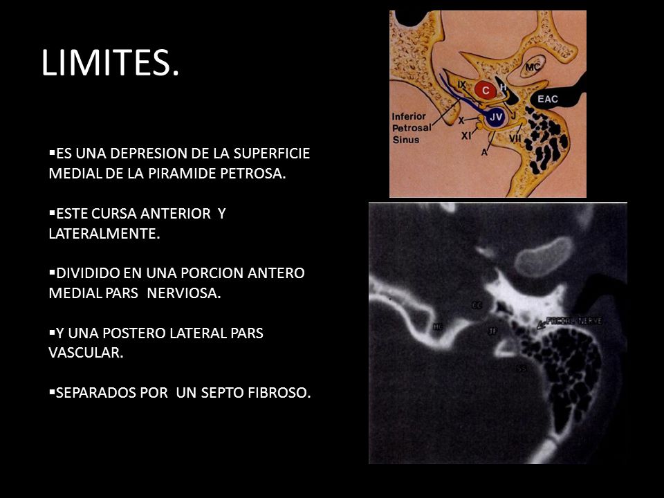 LIMITES. ES UNA DEPRESION DE LA SUPERFICIE MEDIAL DE LA PIRAMIDE PETROSA. ESTE CURSA ANTERIOR Y LATERALMENTE.