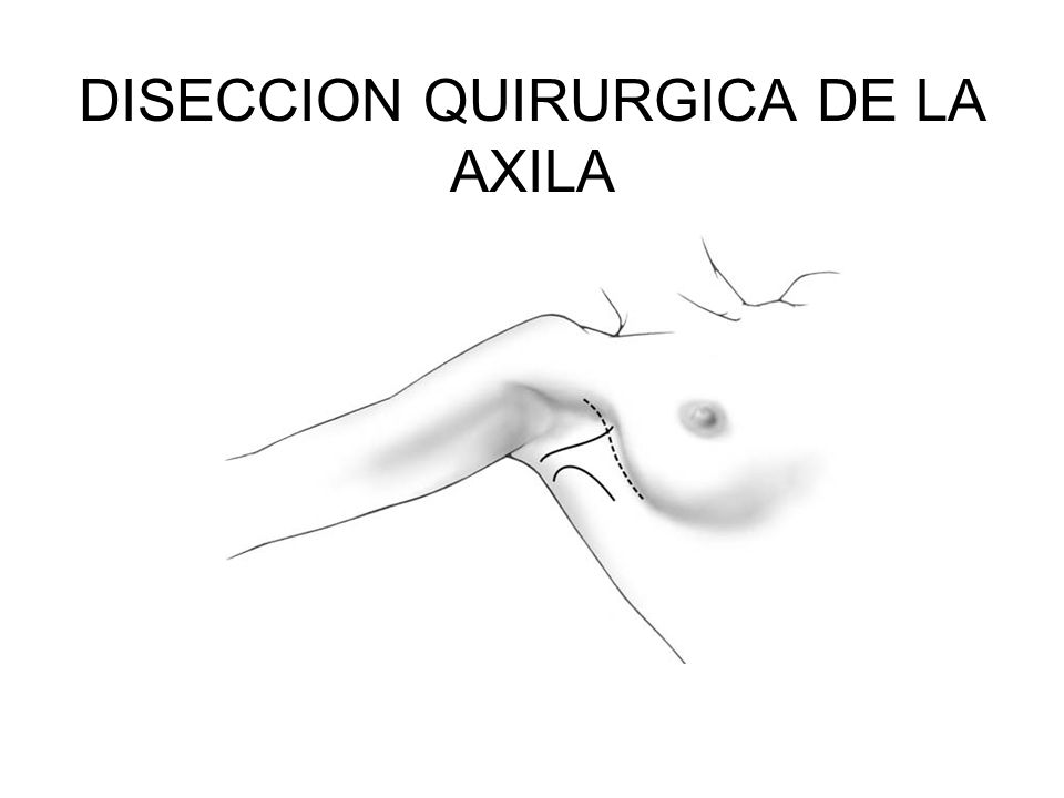 DISECCION QUIRURGICA DE LA AXILA