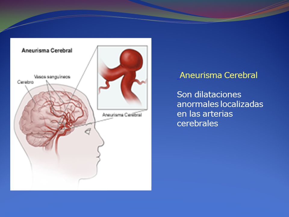 Aneurisma Cerebral Son dilataciones anormales localizadas en las arterias cerebrales