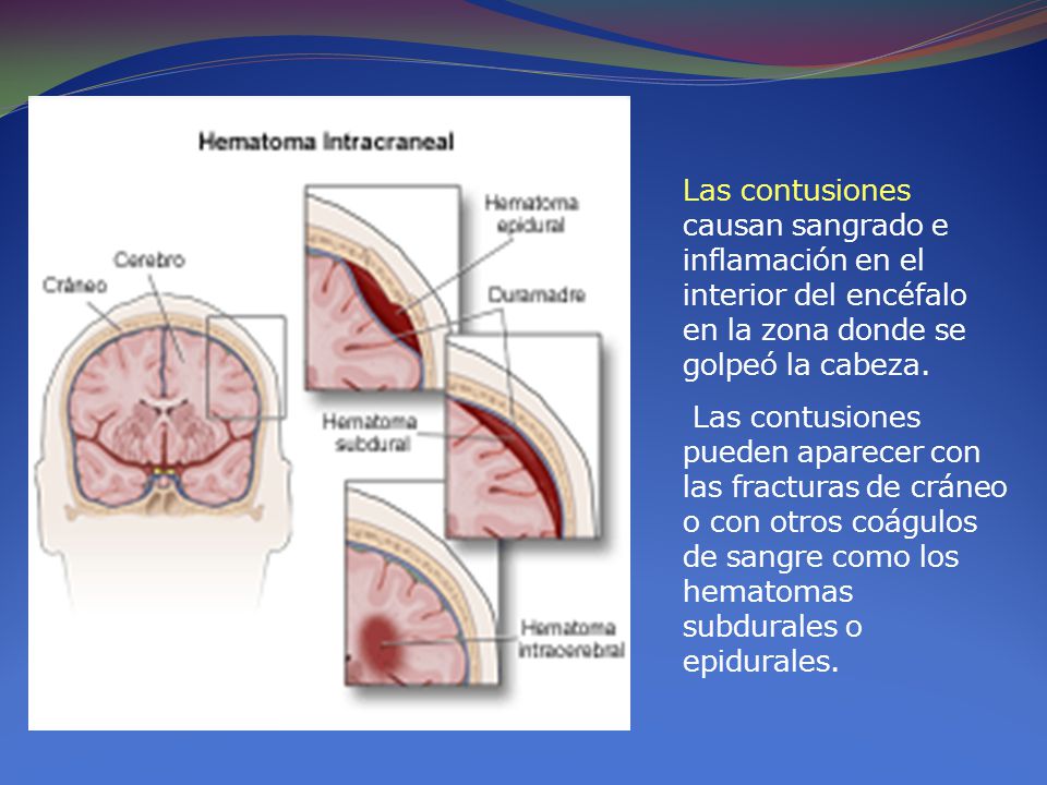 Las contusiones causan sangrado e inflamación en el interior del encéfalo en la zona donde se golpeó la cabeza.