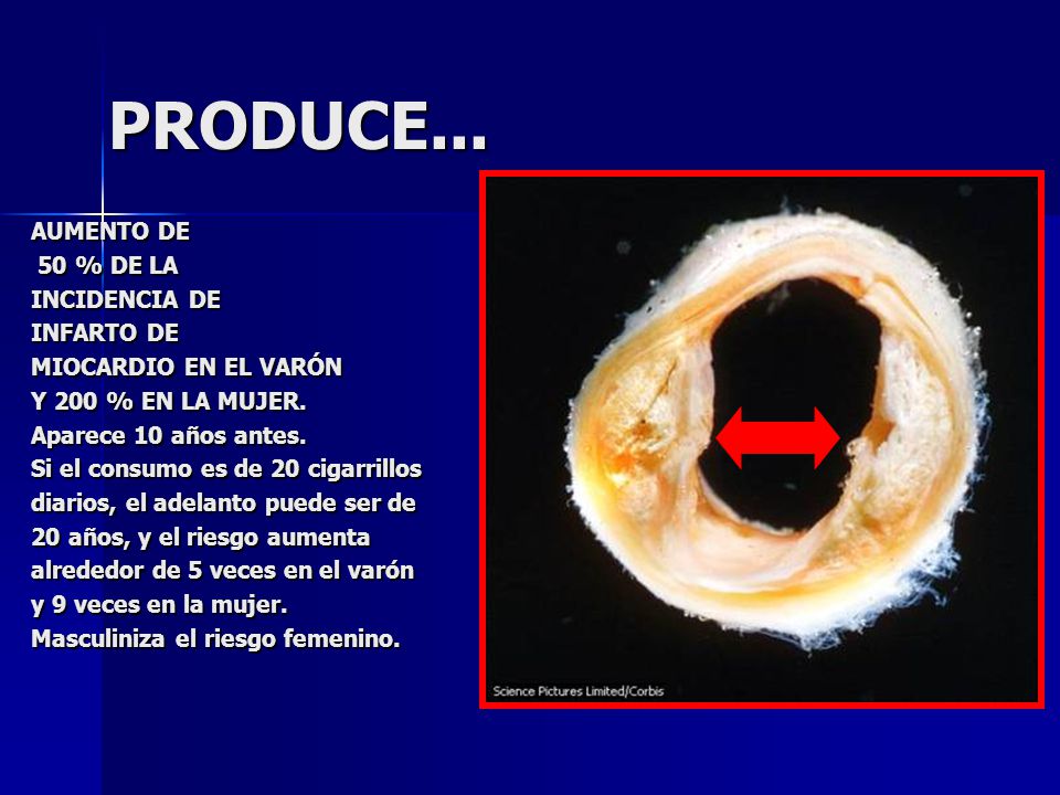 PRODUCE... AUMENTO DE 50 % DE LA INCIDENCIA DE INFARTO DE