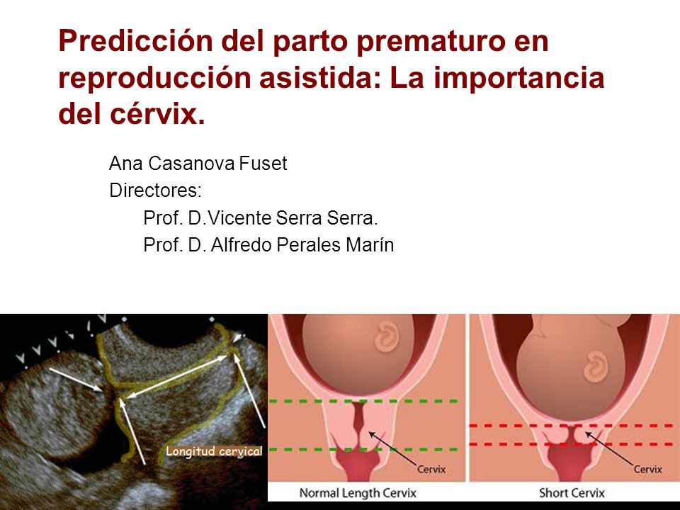 Predicción del parto prematuro en reproducción asistida: La importancia del cérvix.