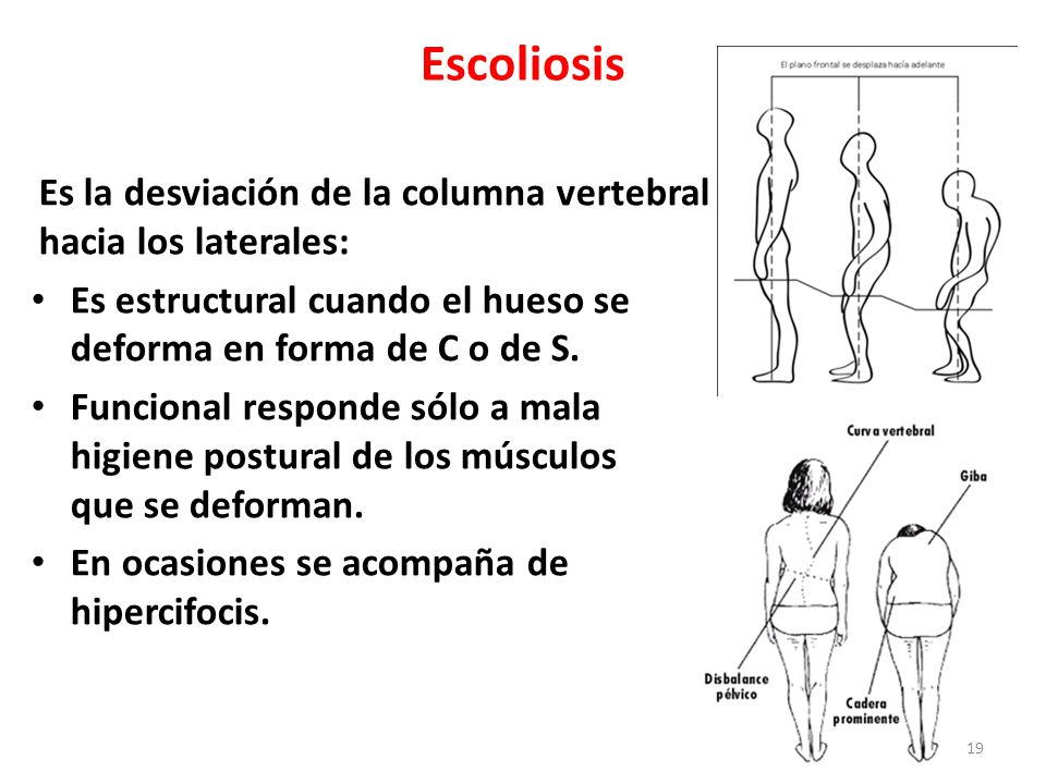 Escoliosis Es la desviación de la columna vertebral hacia los laterales: Es estructural cuando el hueso se deforma en forma de C o de S.