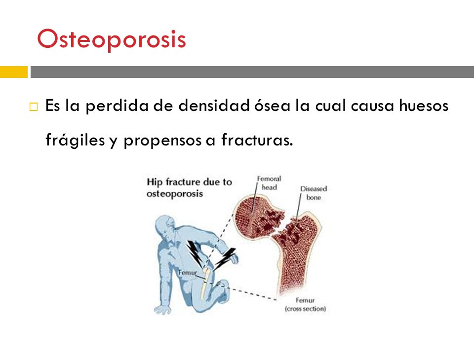Osteoporosis Es la perdida de densidad ósea la cual causa huesos frágiles y propensos a fracturas.