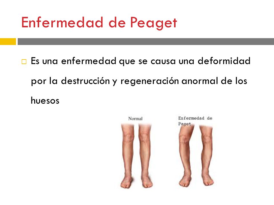 Enfermedad de Peaget Es una enfermedad que se causa una deformidad por la destrucción y regeneración anormal de los huesos.