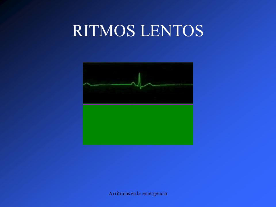 Arritmias en la emergencia