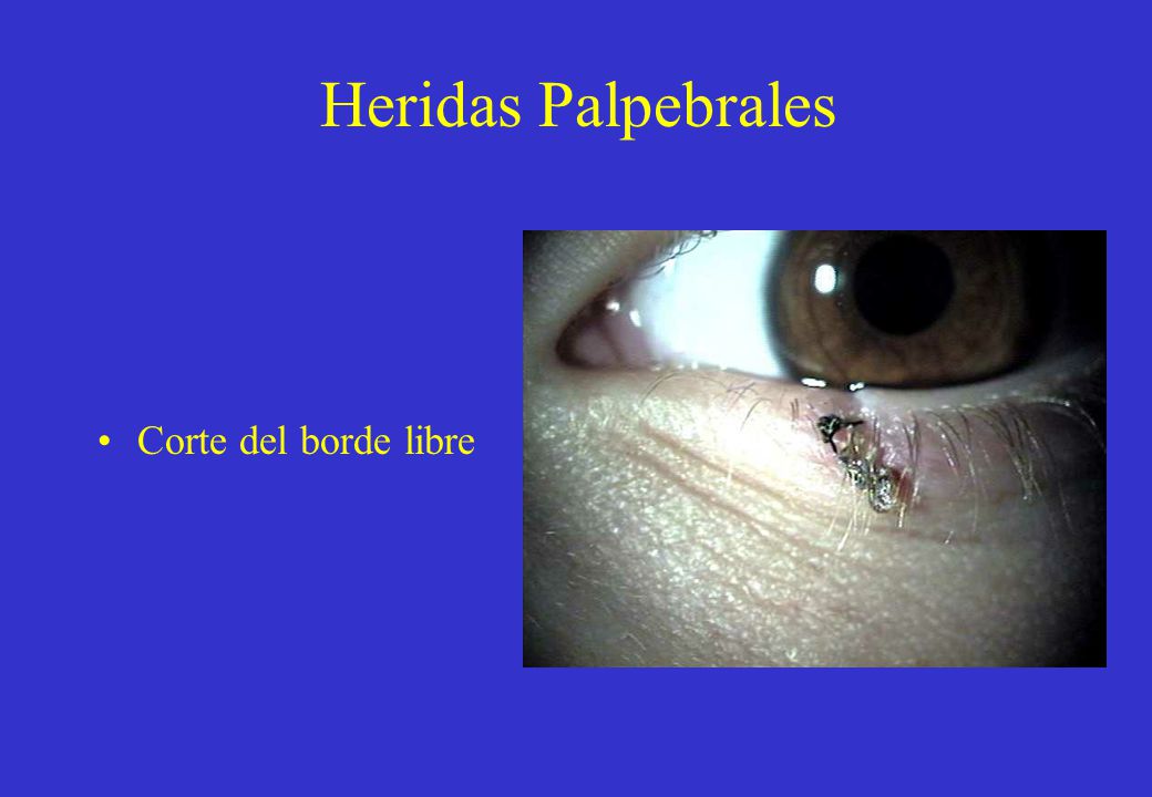 Heridas Palpebrales Corte del borde libre